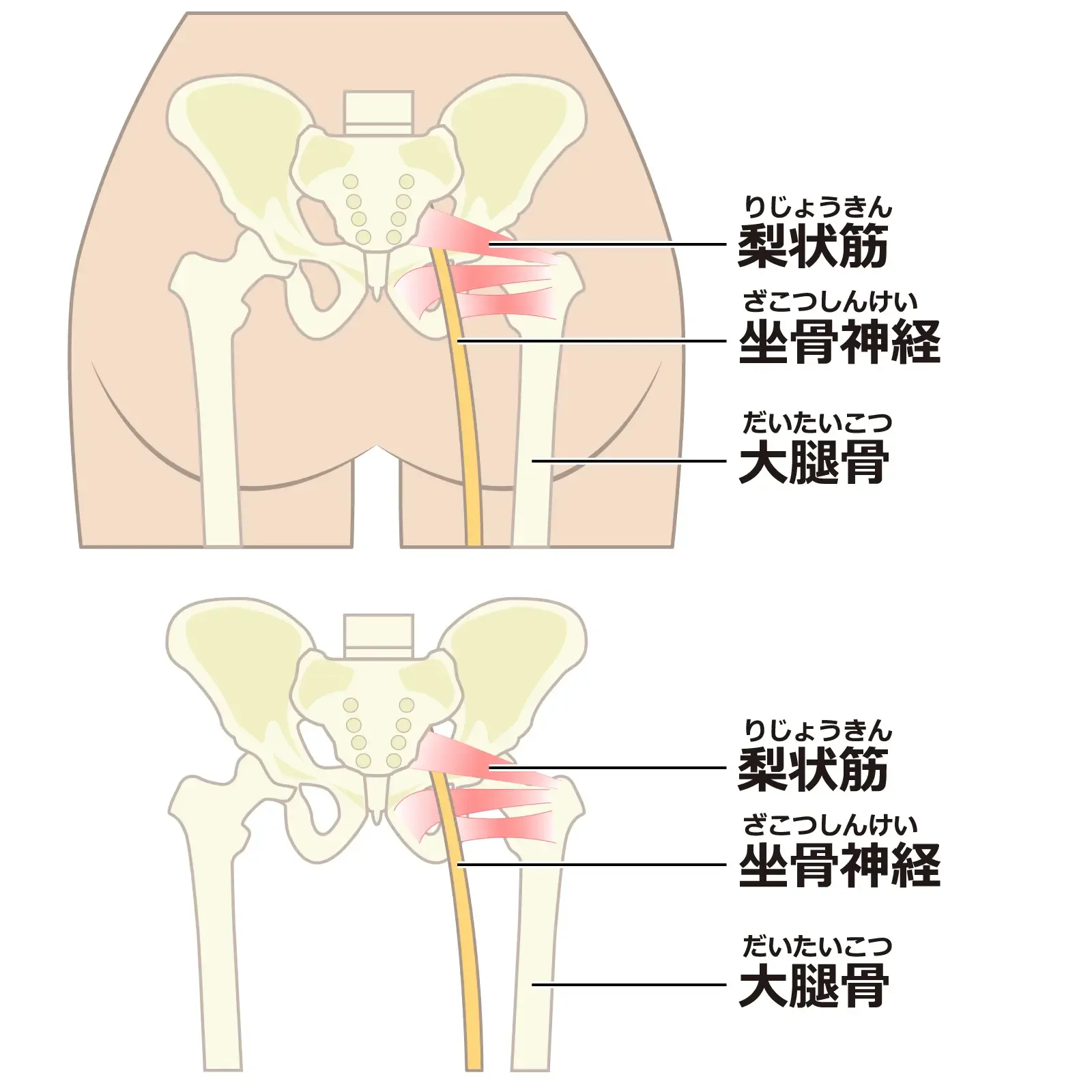 sciatica5.webp